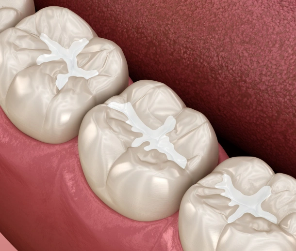 Dental Sealants Panorama City