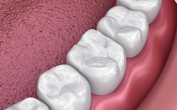 composite fillings 