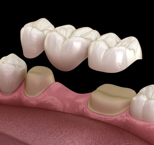 Dental Crowns and Bridges