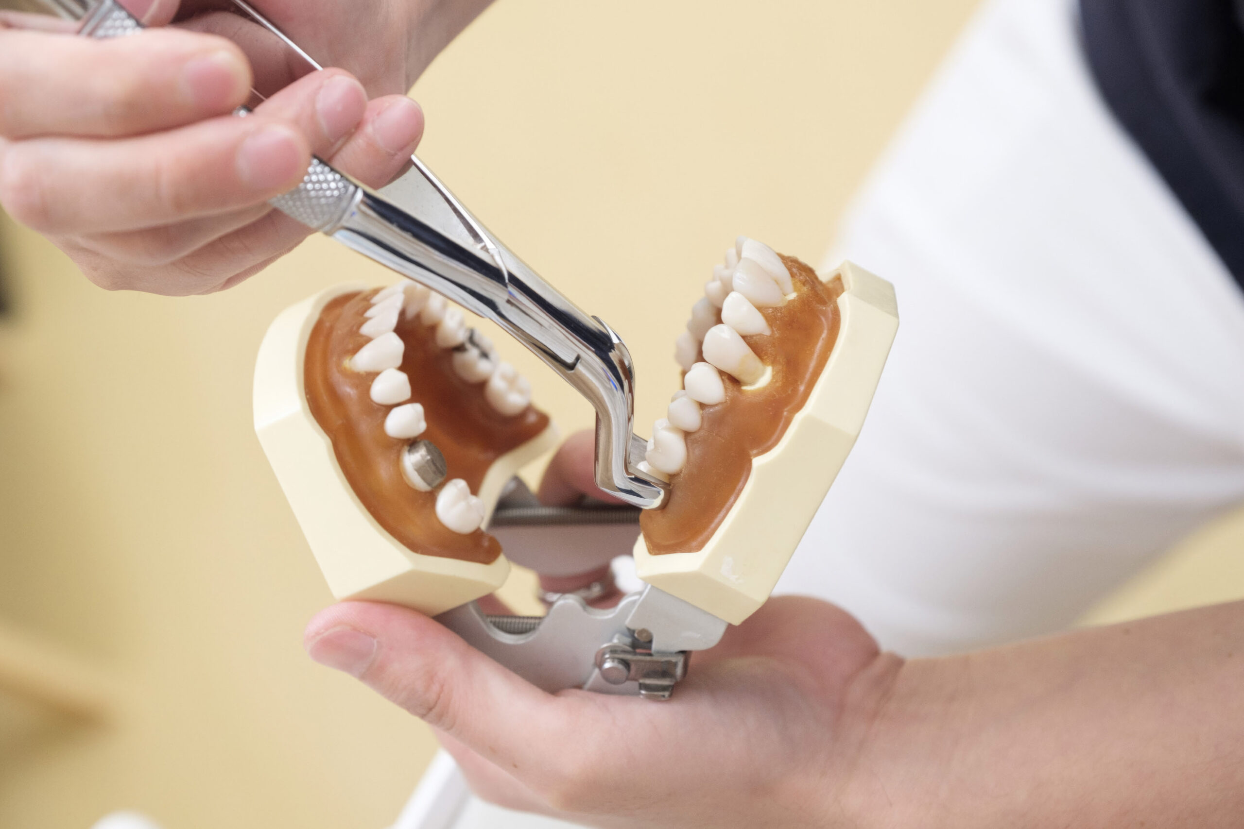 How Long Does a Tooth Extraction Take